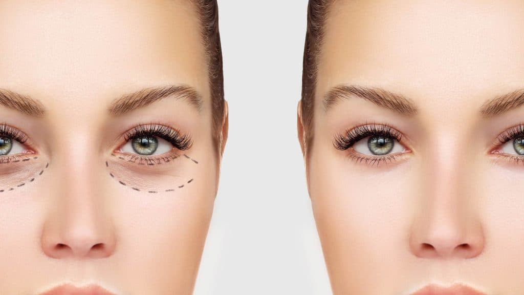 Eye Bag Surgery Lower Lid Blepharoplasty london 1024x576 1