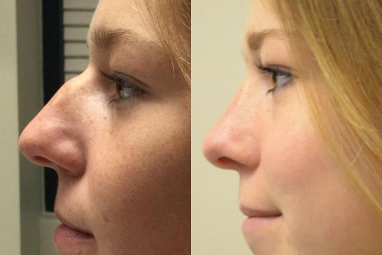 rhinoplastie 69210