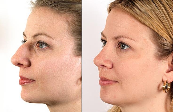 rhinoplasty iran 368