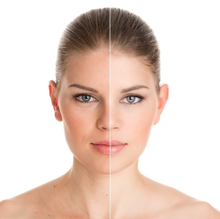 Botox Injections