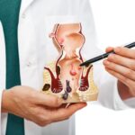 The best hemorrhoid doctor in Sharjah