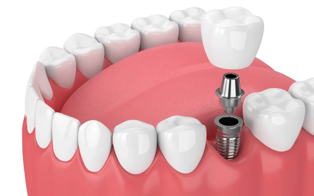 DENTAL IMPLANTS 2