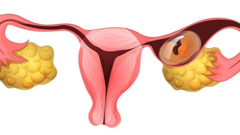 Ectopic Pregnancy