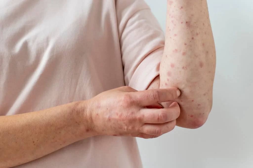 Chickenpox