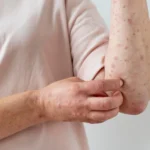 Chickenpox