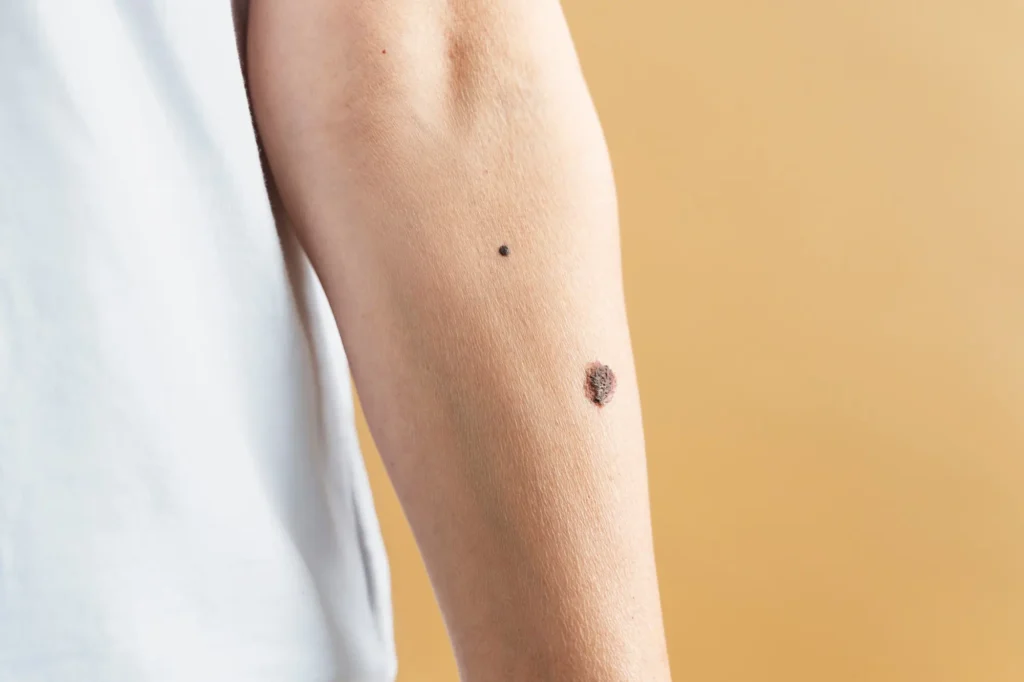 birthmark