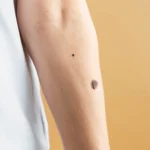 birthmark
