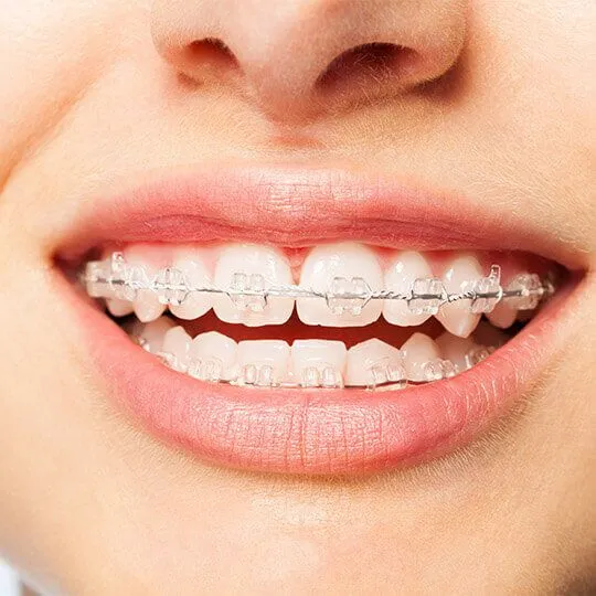 ceramic braces in dubai