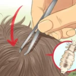 Head Lice in Children